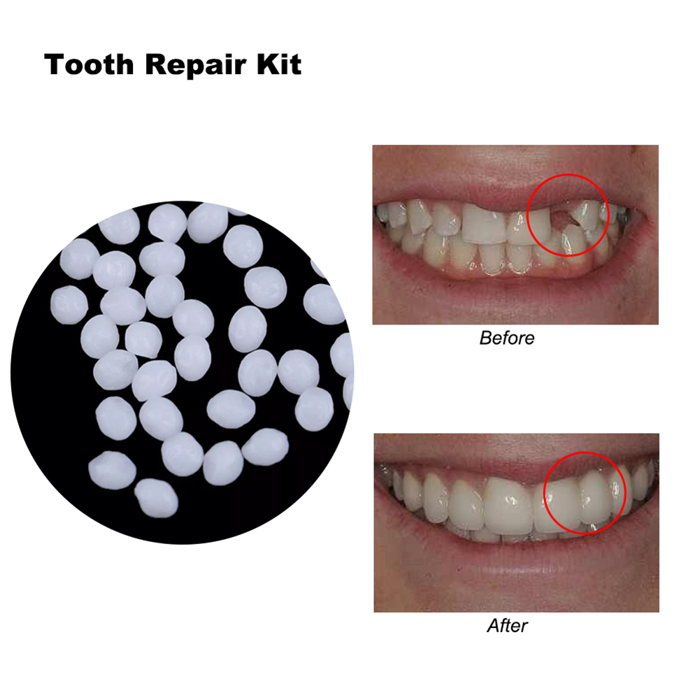 Teeth Whitening Diy - 10/100g DIY Kunstgebitten Bijtring Handgemaakte Massieve