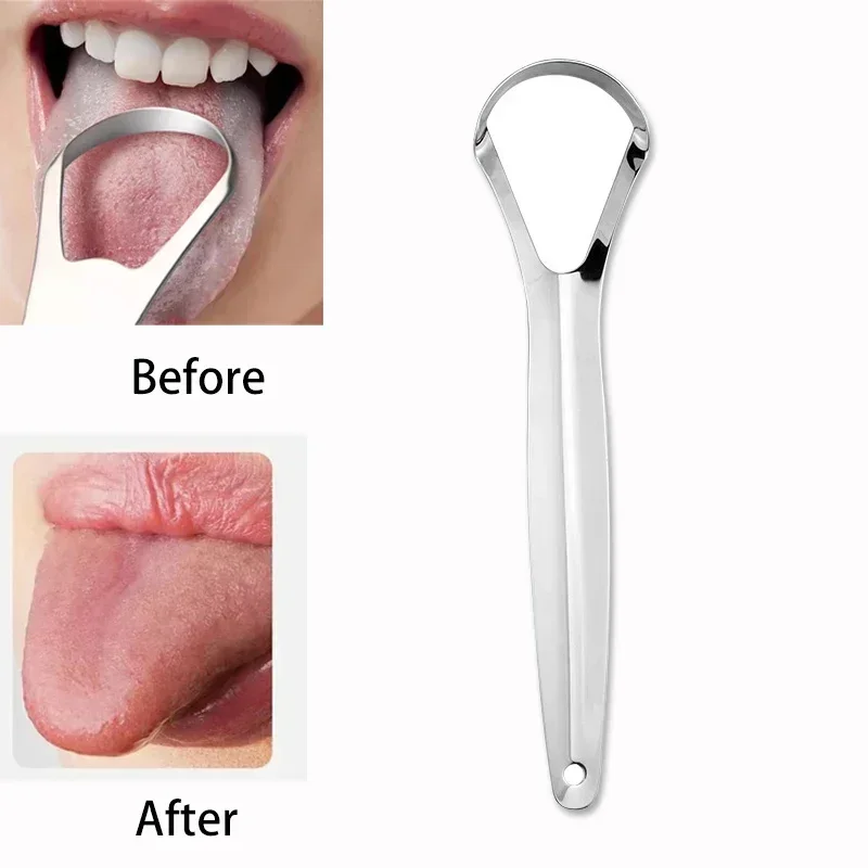 Tongue Scraper Metal - Halitose Tongcoating Tongschraper Roestvrij staal Reinigingsverwijderaar