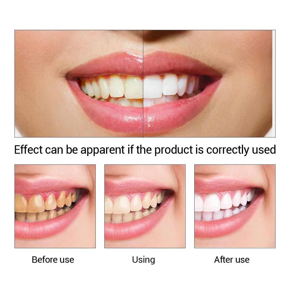 Fteenply Tanden Whitening Esse - Teeth Whitening Diy recensie en prijs