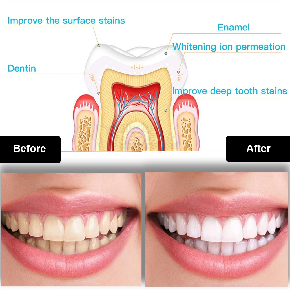 Tandheelkundige Tanden Whiteni - Teeth Whitening Diy recensie en prijs