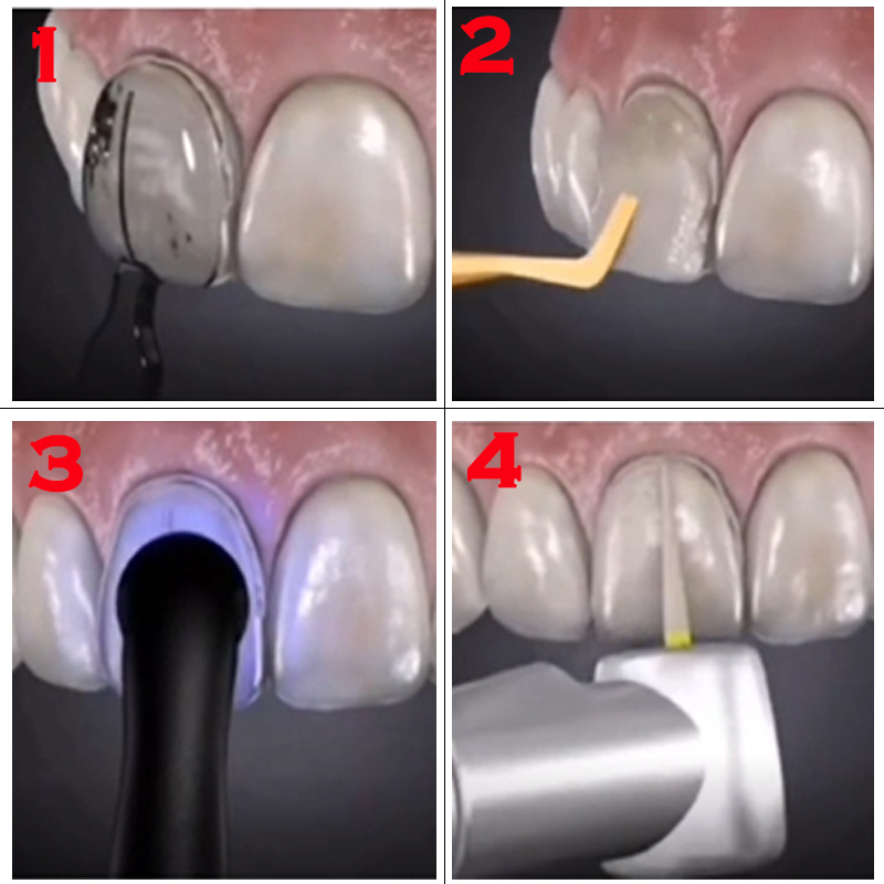 Autoclaveerbare tandvleugelmal - Teeth Whitening Quick recensie en prijs